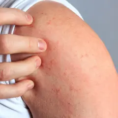 Alergia na tle nerwowym: objawy, jak rozpoznać i leczyć