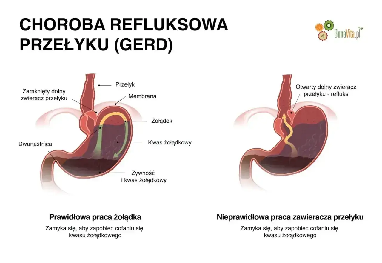 Ilustracja pokazuje prawidłowe i nieprawidłowe działanie zwieracza przełyku, wyjaśniając mechanizm refluksu.