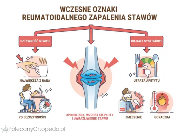 Wczesne objawy reumatoidalnego zapalenia stawów: sztywność, opuchlizna, zmęczenie, gorączka, utrata apetytu.