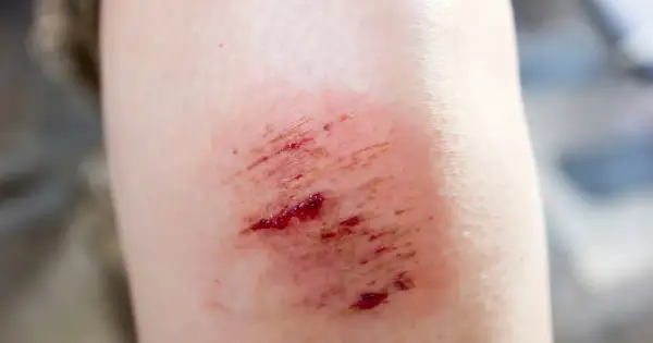 Otarte otarte kolano, zaczerwienione i lekko krwawiące. Potrzebuje **oktaseptal** do dezynfekcji.